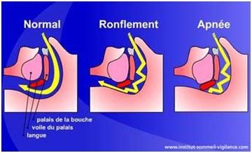 Traitement de l'apnée du sommeil à domicile en Finistère et Bretagne Traitement de l'apnée du sommeil à domicile en Finistère et Bretagne